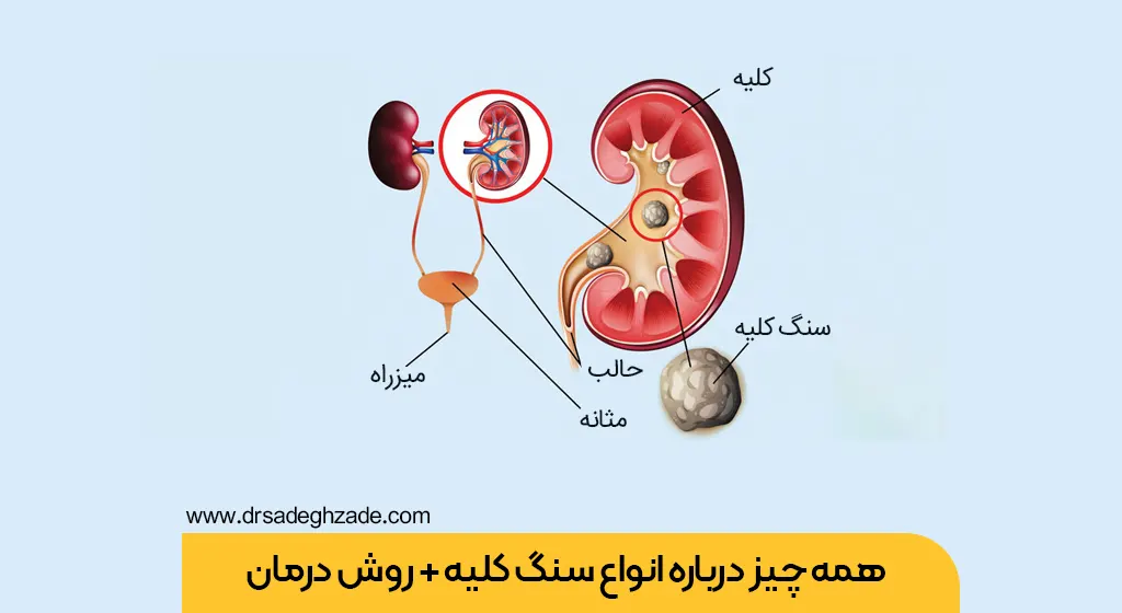 سنگ کلیه