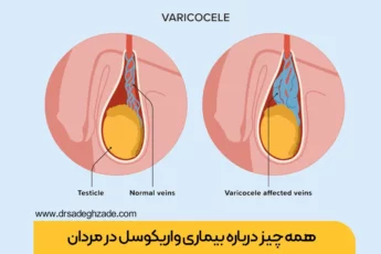 واریکوسل چیست