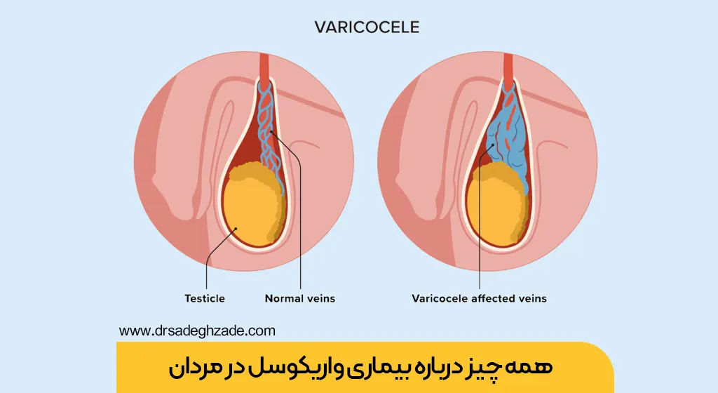 واریکوسل چیست