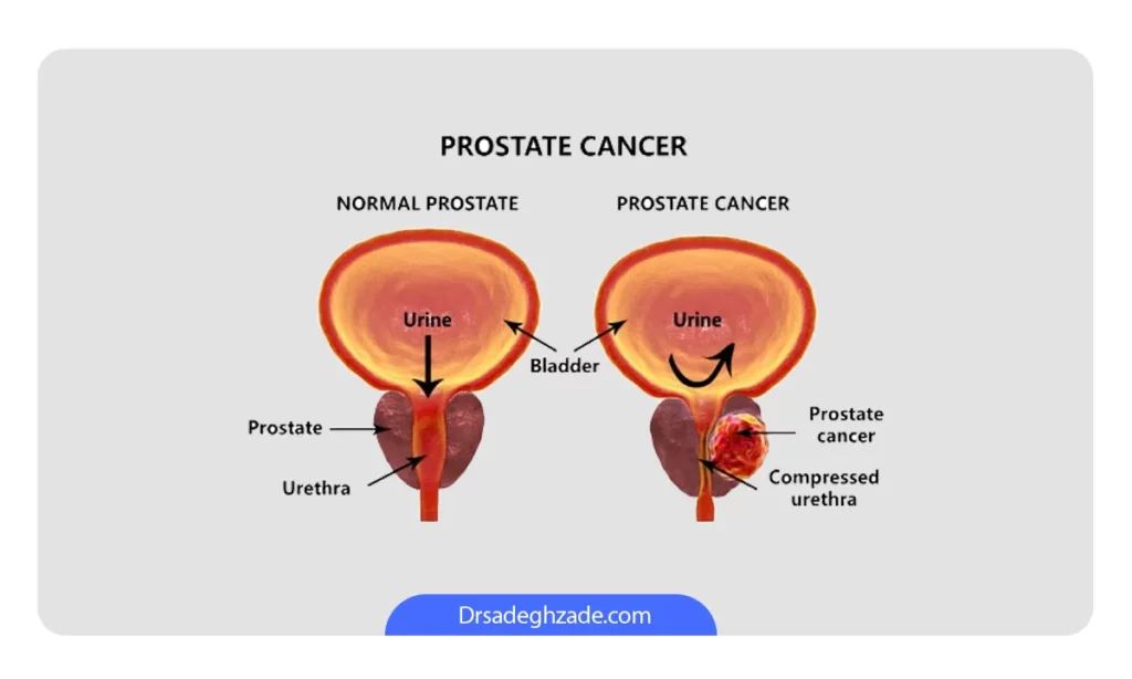 عکس پروستات سالم و پروستات دچار سرطان