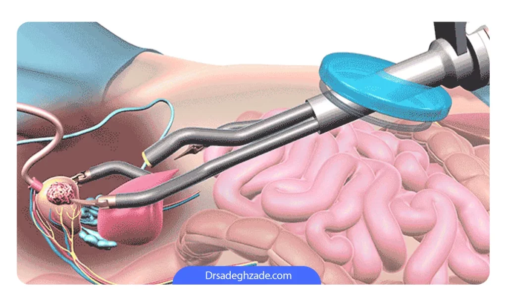 عکس کرایوسرجری سرطان پروستات