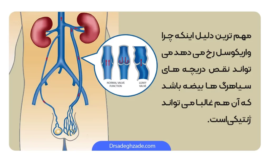 اینفوگرافی علل واریکوسل