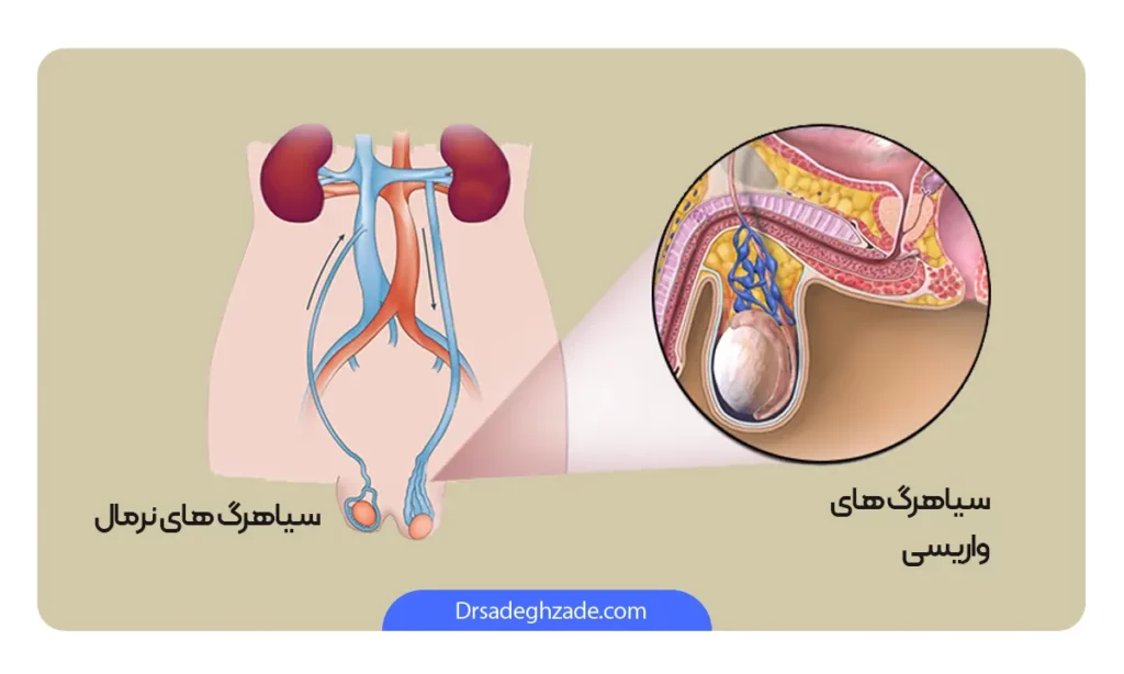 بررسی سیاه رگ های طبیعی و ناسالم بیضه ها به صورت شماتیک