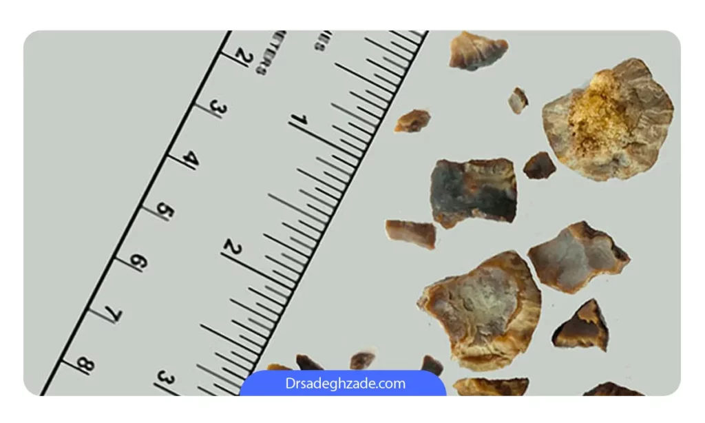 سنگ کلیه های مناسب برای انجام عمل rirs