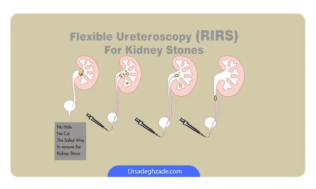 اینفوگرافی عمل جراحی RIRS