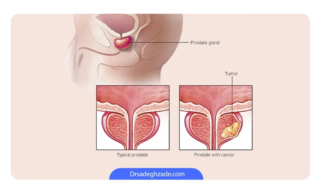 اینفوگرافی آبسه پروستات