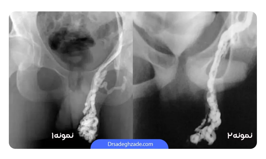 عکس واریکوسل درخواست شده توسط متخصص ارولوژی