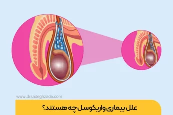 علت واریکوسل