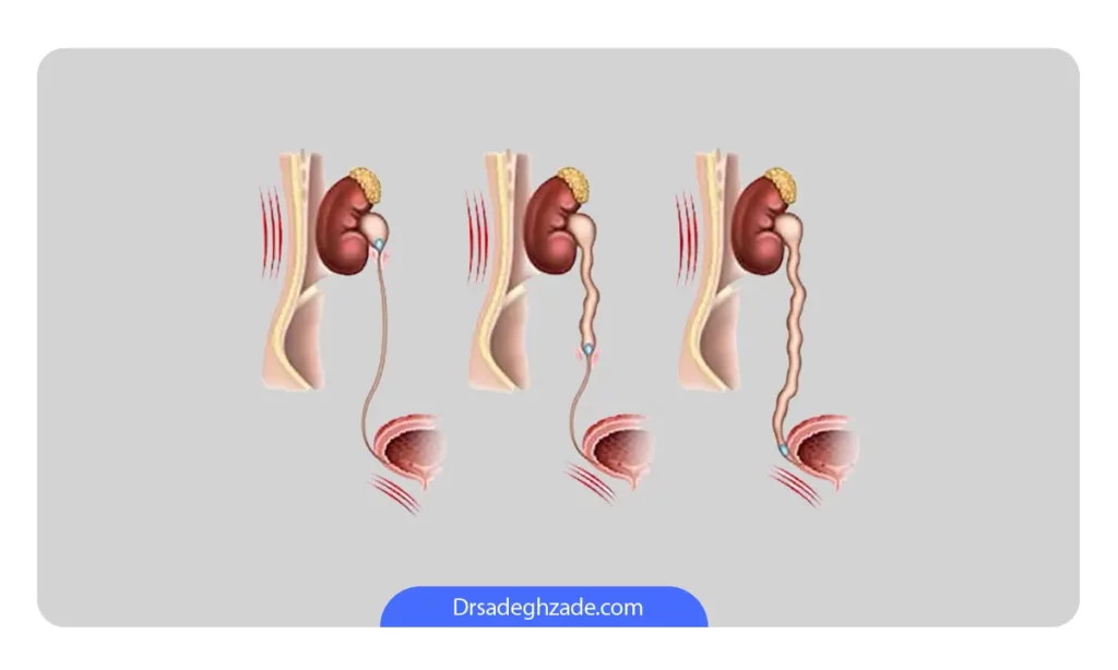 عکس حرکت سنگ از کلیه به سمت مثانه (به ویژه در حالب)